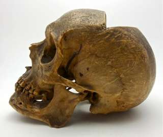   Human Skull   Genuine Skeleton   RARE Star Shaped Calvarium Cut  