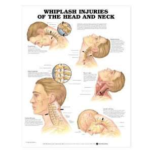 Whiplash Injuries of the Head and Neck Chart